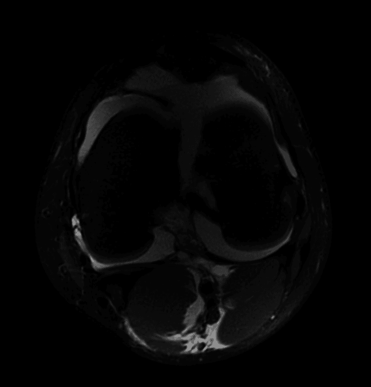 Axial MRI of a distal femoral Salter-Harris type IV fracture