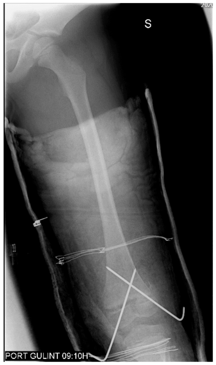 Postoperative radiograph of crossed smooth Kirschner-wire fixation of a distal femoral physeal fracture