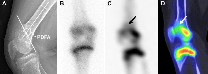 Radiograph, bone scan and SPECT CT of distal femoral physeal arrest with genu recurvatum