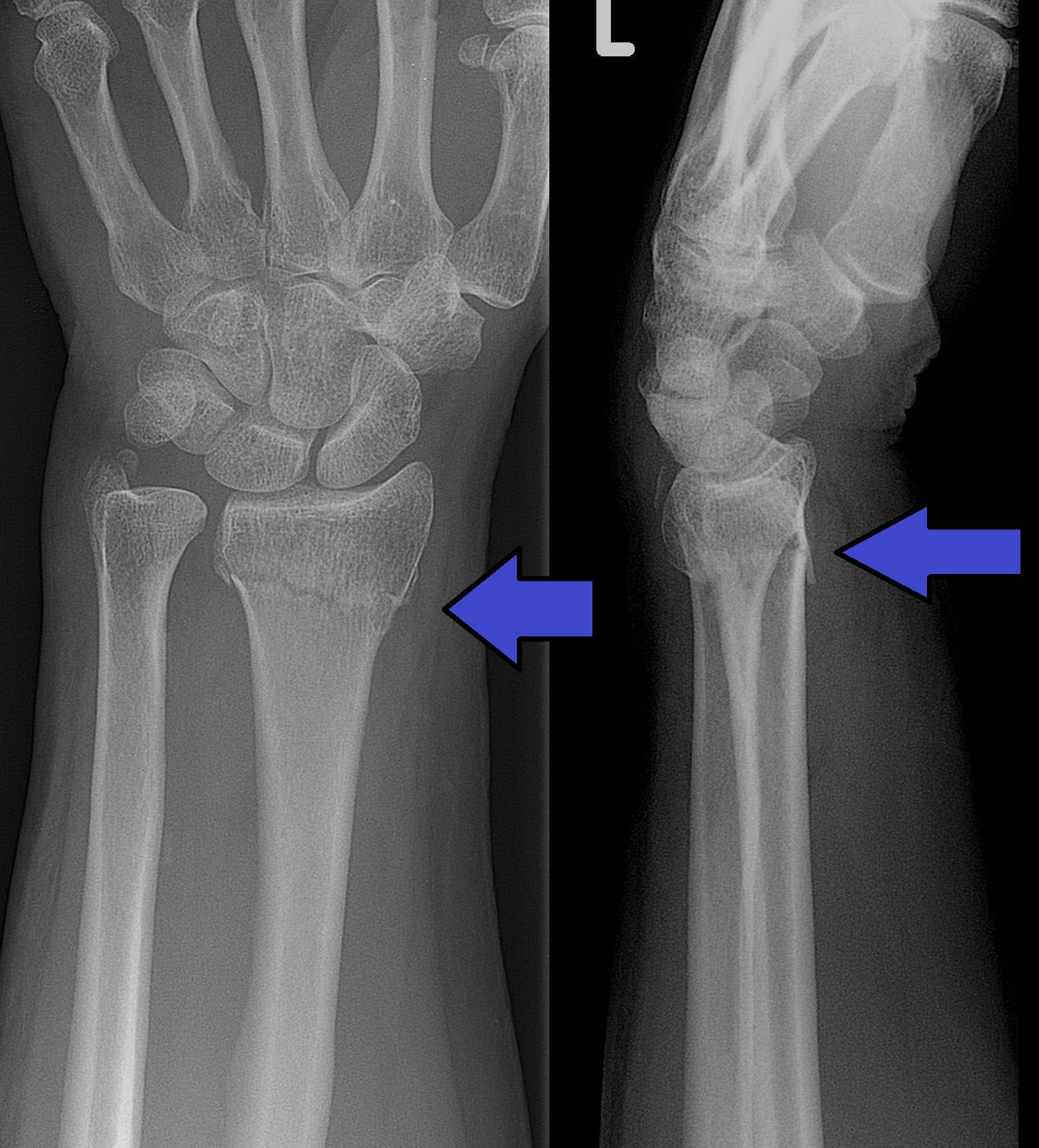Colles fracture X-ray showing dorsal angulation of distal radius with ulnar styloid fracture