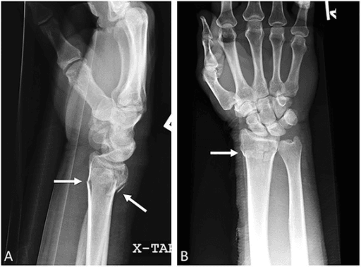 Classic Colles fracture showing dorsal angulation on lateral and AP views