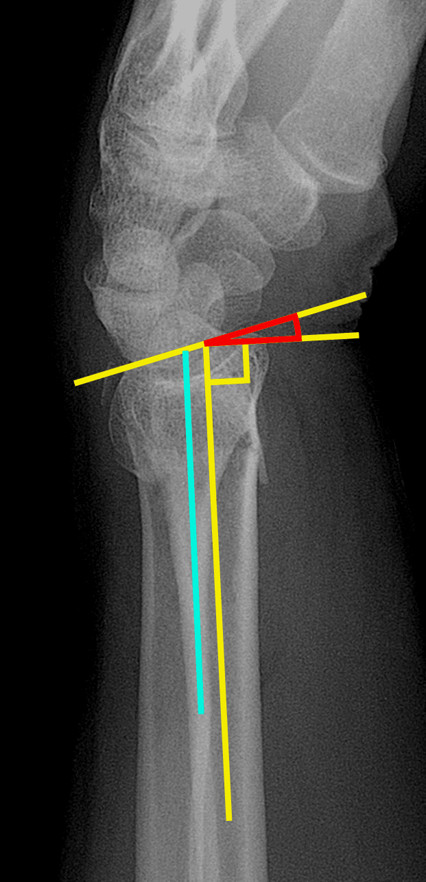 Lateral radiograph showing how to measure dorsal tilt of distal radius fracture