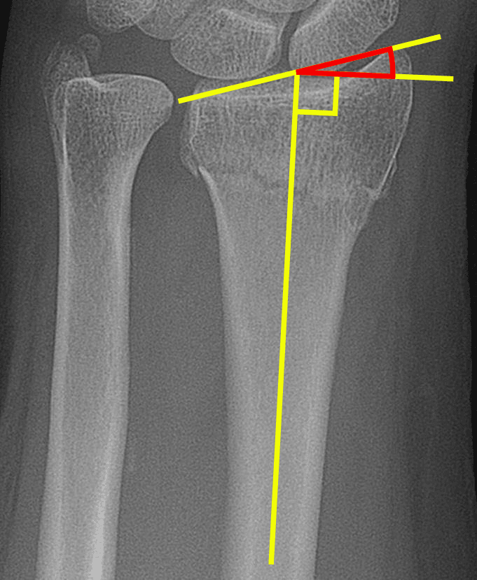 AP radiograph showing how to measure radial inclination