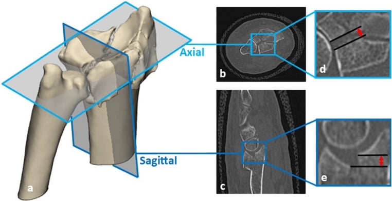 3D CT model and multiplanar CT slices showing gap and step-off measurements in a distal radius fracture