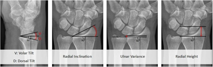 Schematic representation of standard wrist radiographic alignment parameters