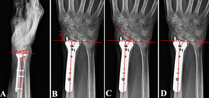 Radiographic measurement lines demonstrating volar tilt, radial height, and radial inclination