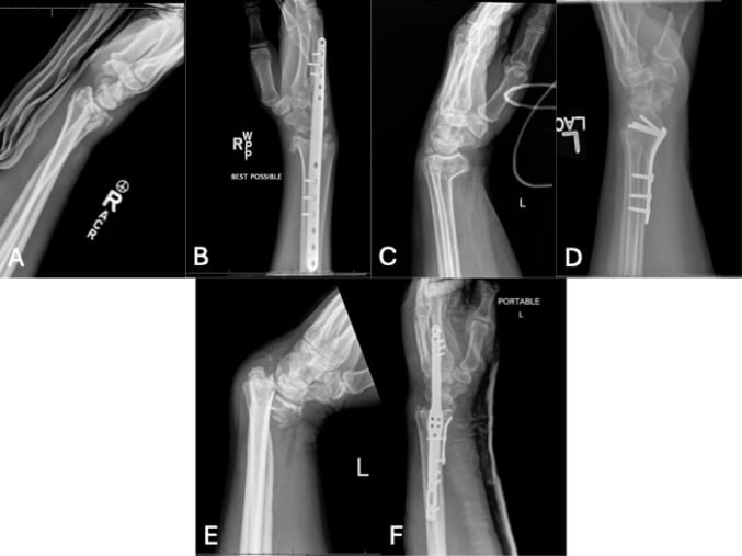 Radiographs of surgical fixation constructs for intra-articular distal radius fractures