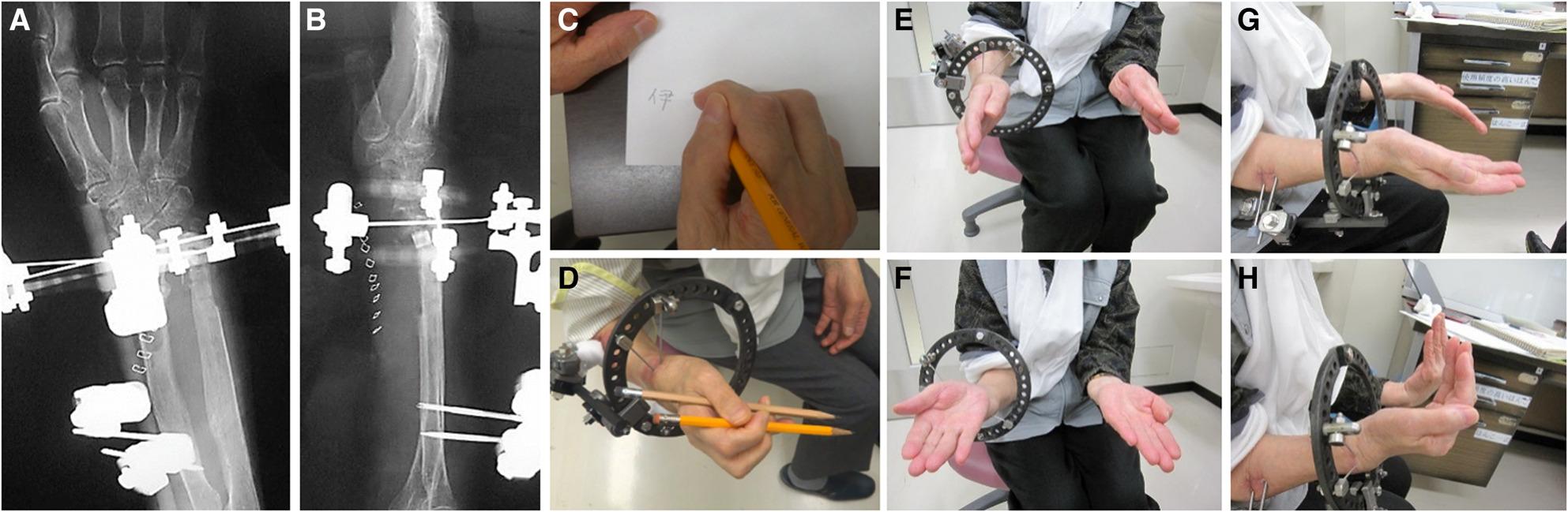 Clinical photograph and radiographs of non-bridging external fixator for distal radius fracture