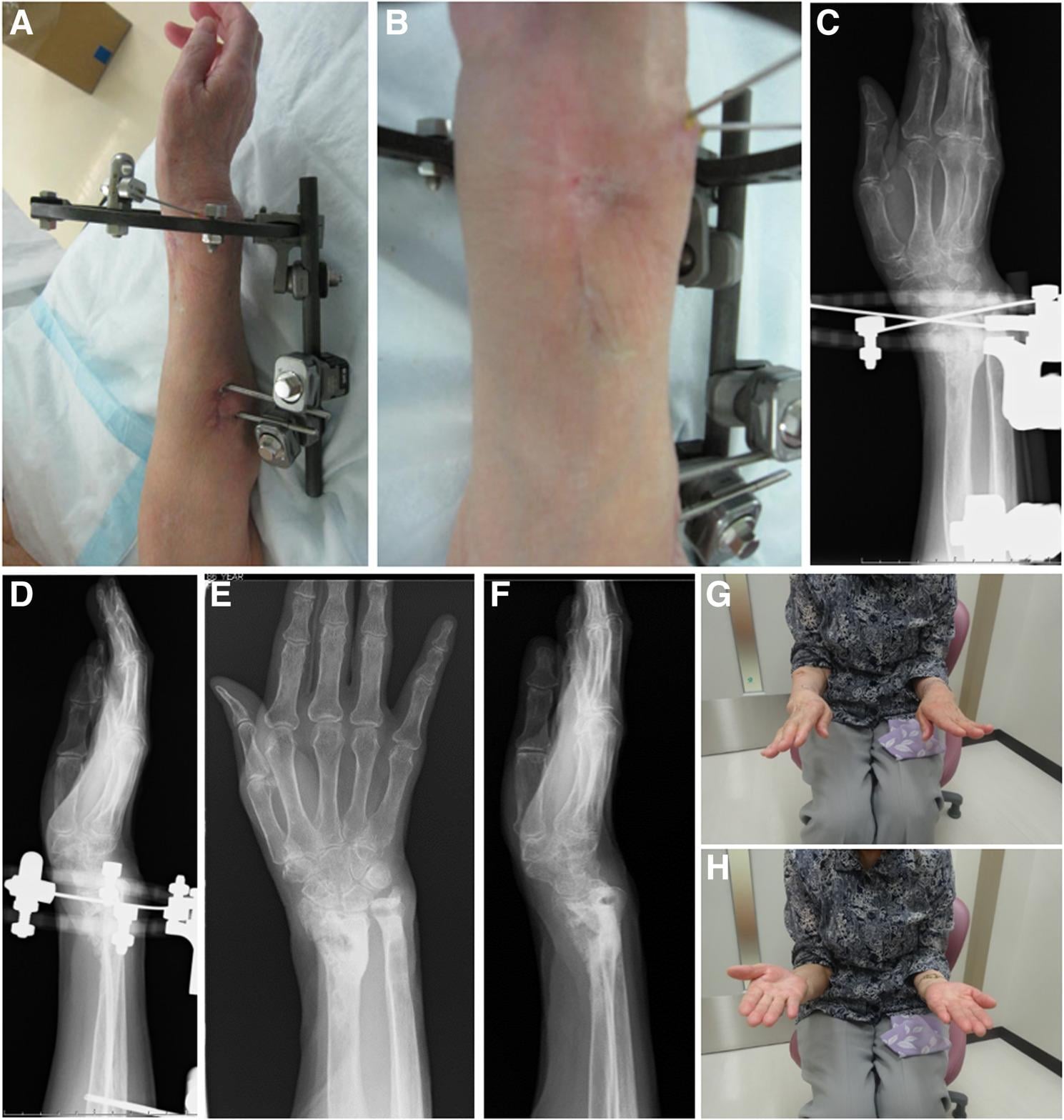Postoperative radiographs showing complete distal radius fracture consolidation