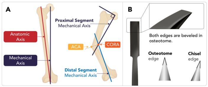 Schematic diagram illustrating anatomical axis, mechanical axis, and CORA for distal radius malunion correction