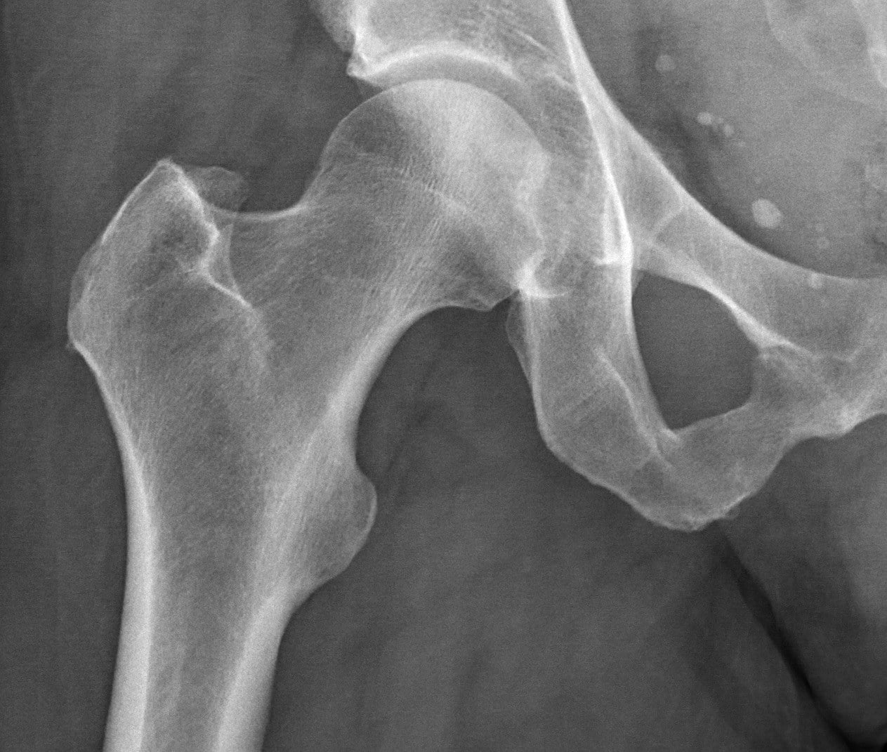 AP radiograph of a proximal femur showing the cortical thickness and medullary canal morphology assessed in the Dorr classification