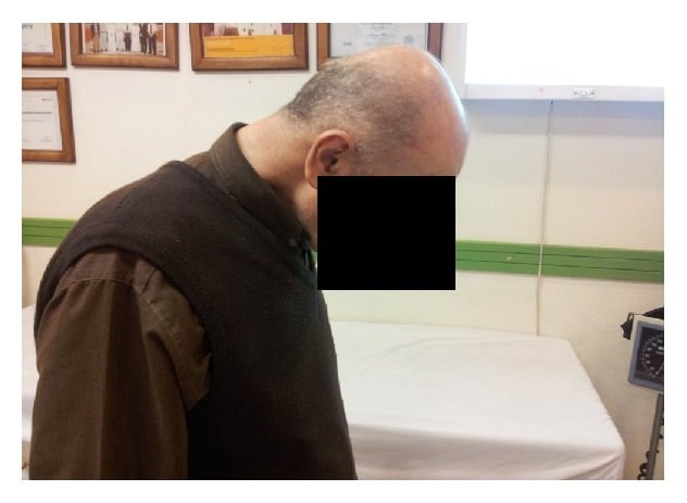 Clinical photograph showing elderly male with dropped head syndrome in chin-on-chest posture