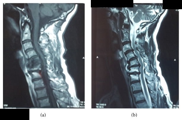 Two-panel sagittal cervical MRI showing T1 and T2-weighted images
