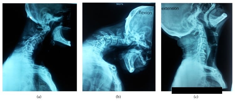 Three-panel lateral cervical radiograph series showing neutral, flexion, and extension views
