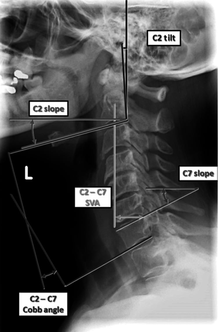 Lateral cervical radiograph annotated with C2 to C7 Cobb angle sagittal vertical axis C2 tilt C2 slope and C7 slope