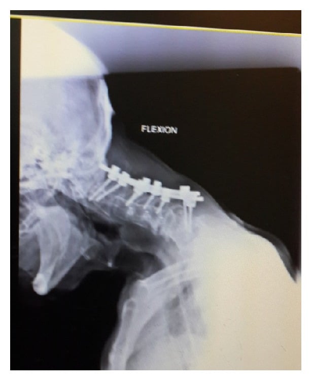 Lateral cervical radiograph showing distal C7 pedicle screw pullout after dropped head deformity reconstruction