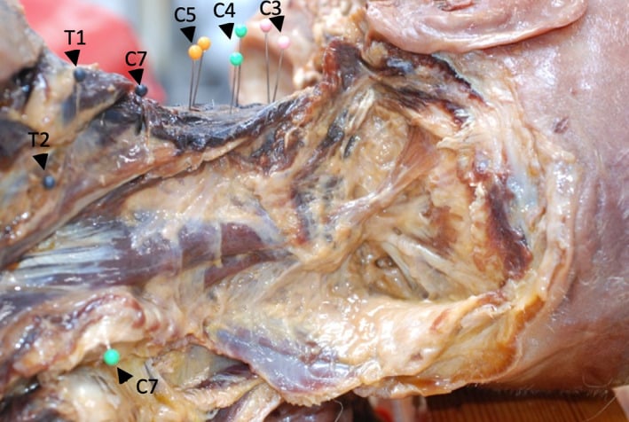 Posterior cadaveric dissection of the deep cervical muscle layers with segmental nerve roots labelled