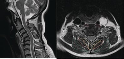 Sagittal and axial T2 MRI of dropped head syndrome with longus colli semispinalis cervicis splenius capitis and multifidus segmented