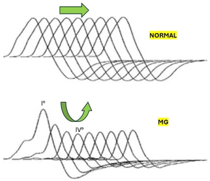 Comparison of normal repetitive nerve stimulation with the decremental compound muscle action potential response of myasthenia gravis