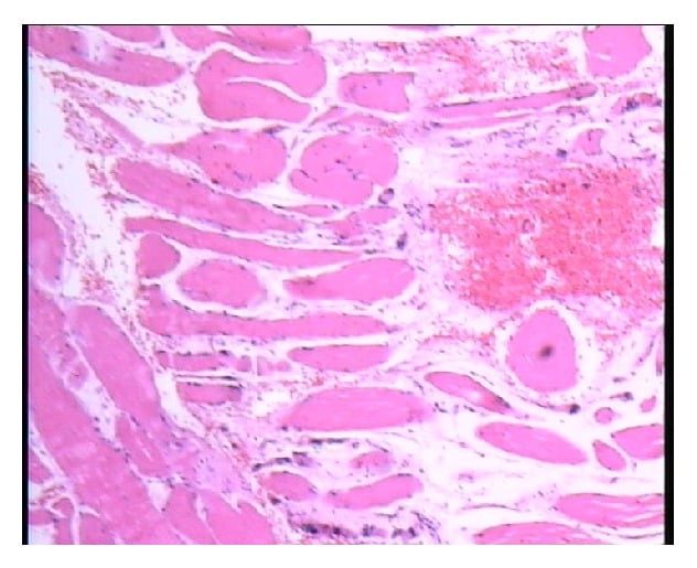 Haematoxylin and eosin muscle biopsy showing fibre-size variation and scattered atrophic fibres in dropped head syndrome