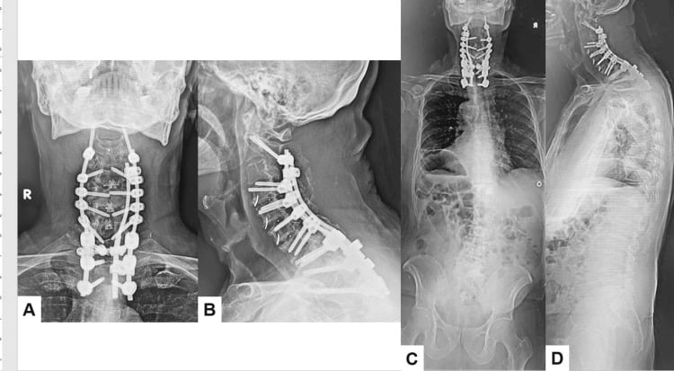 Postoperative cervical and whole-spine radiographs showing corrected alignment after circumferential dropped head reconstruction