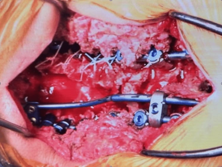 Intraoperative posterior cervicothoracic construct using three rods after deformity correction