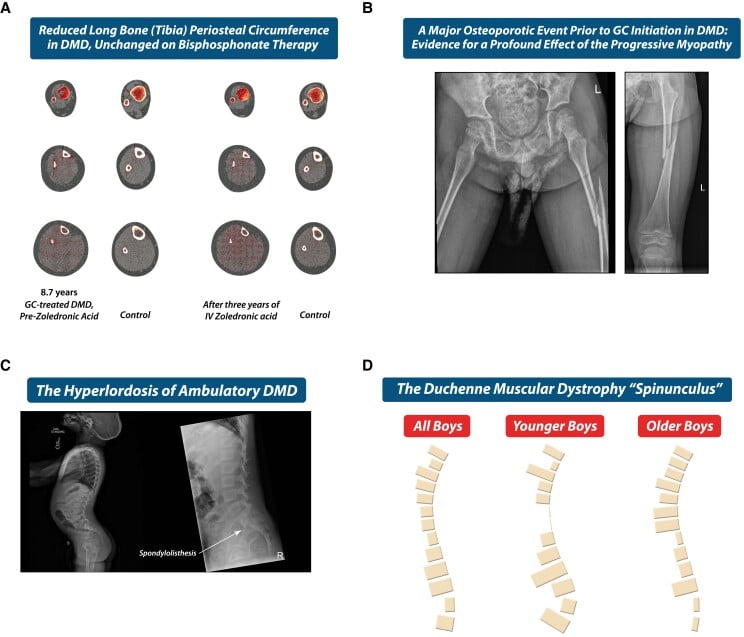 Composite illustrating reduced tibial periosteal circumference, long-bone fracture, hyperlordosis and characteristic vertebral deformity in Duchenne muscular dystrophy.