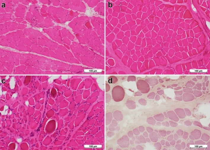 H and E muscle sections from children with Duchenne muscular dystrophy at increasing ages showing progressive fibre variation, necrosis, fibrosis and fatty replacement.