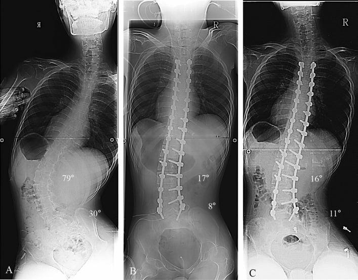 Preoperative and postoperative whole-spine radiographs of Duchenne muscular dystrophy scoliosis showing correction of a 79-degree curve and pelvic obliquity.