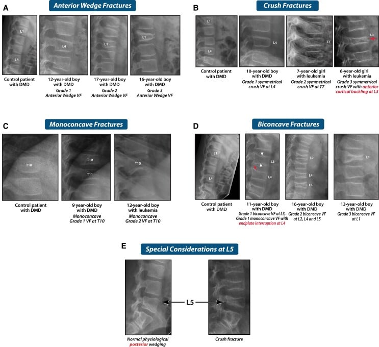 Lateral spine radiographs showing anterior wedge, crush, monoconcave and biconcave vertebral fractures in children with Duchenne muscular dystrophy.