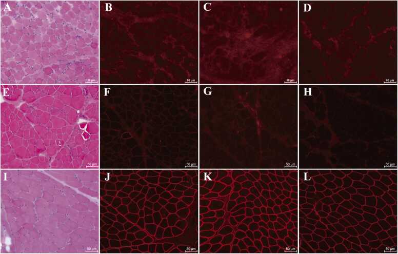 Muscle biopsy panels showing dystrophic histology and absent dystrophin immunofluorescence compared with normal sarcolemmal staining.