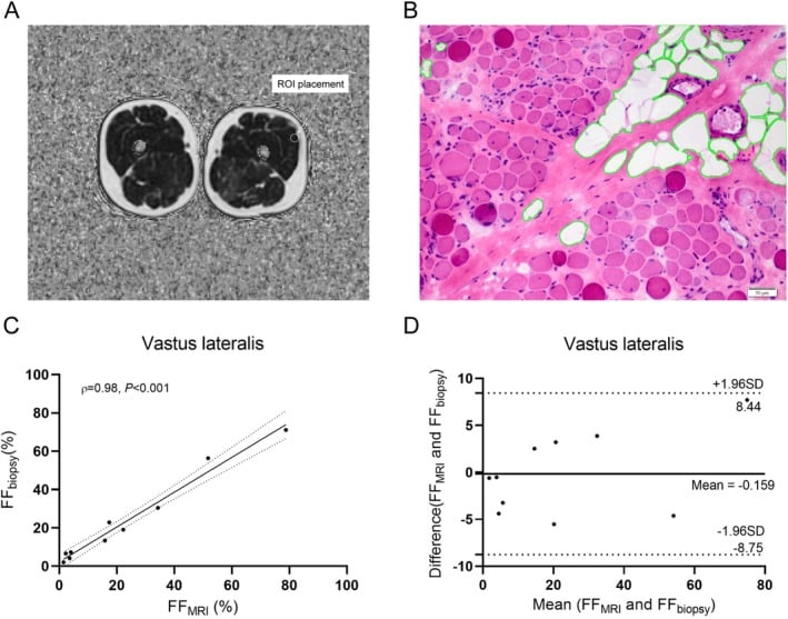 Axial thigh MRI, vastus lateralis histology and correlation plots linking MRI fat fraction with histological fatty infiltration in Duchenne muscular dystrophy.
