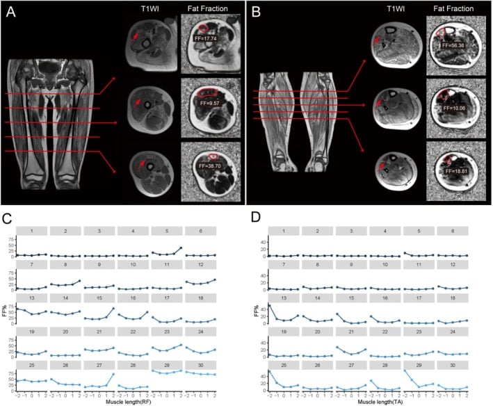 Whole-length muscle MRI and fat-fraction maps showing non-uniform fatty replacement of rectus femoris and tibialis anterior in Duchenne muscular dystrophy.