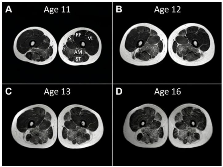 Serial axial thigh MRI from ages 11 to 16 showing progressive symmetric fatty replacement in Duchenne muscular dystrophy.