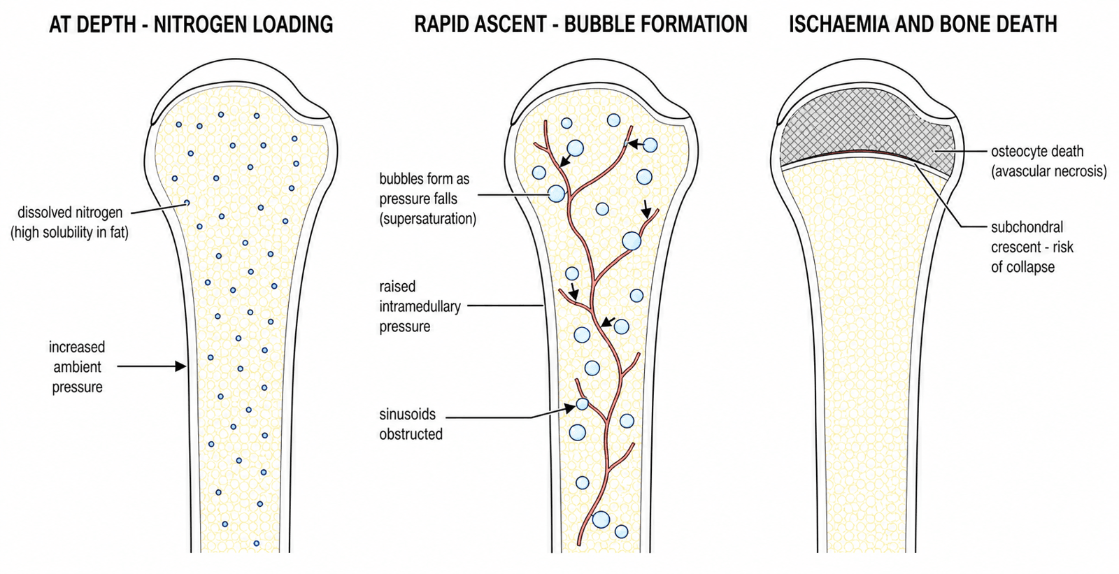 Schematic diagram of the three-stage bubble mechanism of dysbaric osteonecrosis in the proximal humerus