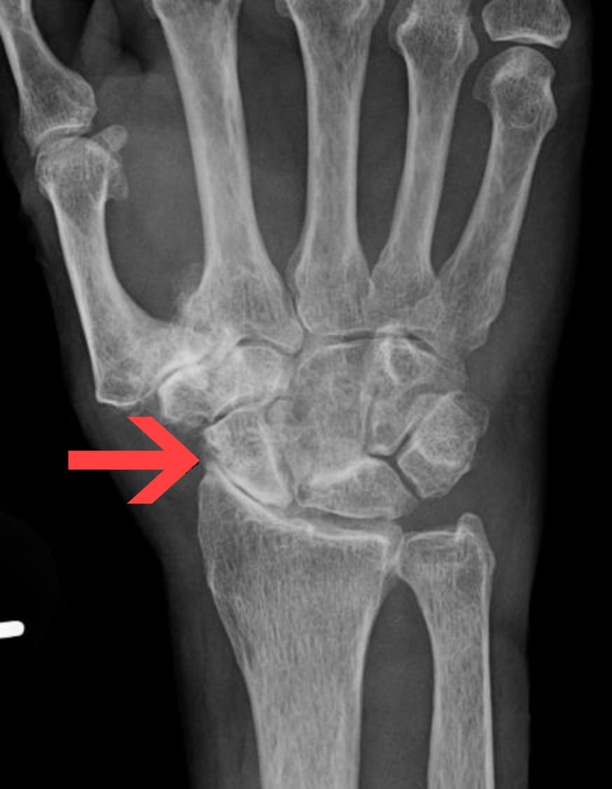 PA wrist radiograph showing osteoarthritis at the thumb base and carpus, with an arrow marking peritrapezial degenerative change.