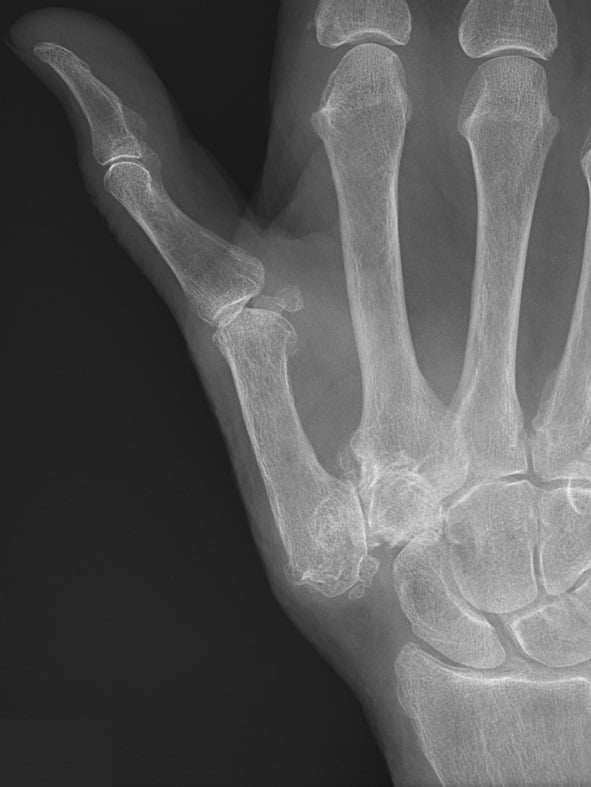 PA hand radiograph showing severe trapeziometacarpal osteoarthritis with radial subluxation of the thumb metacarpal base.