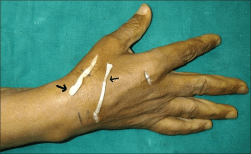 Dropped thumb deformity from EPL rupture