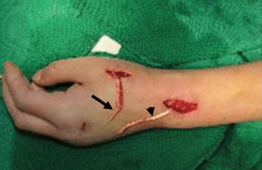 Surgical incisions for EIP to EPL transfer