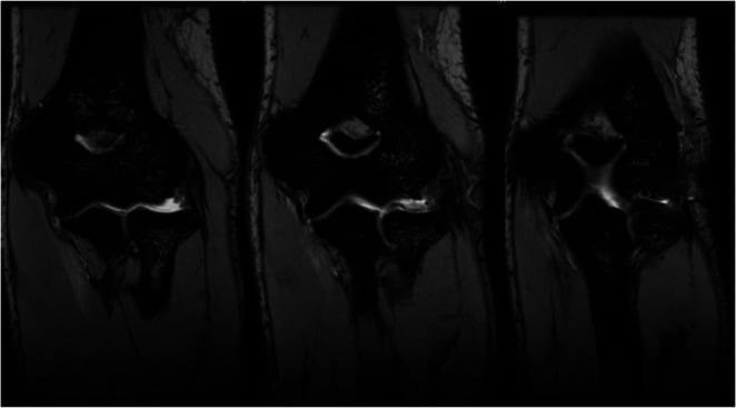 Serial coronal T2 MRI images showing a distal elbow UCL tear near the sublime tubercle