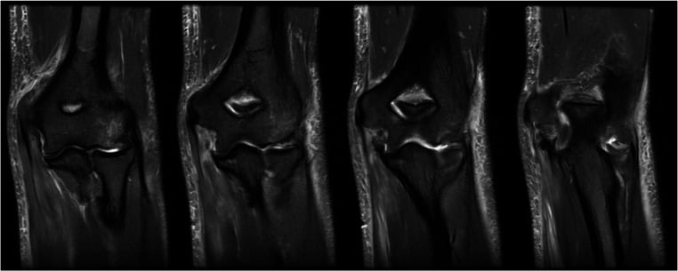 Serial coronal proton-density MRI images showing a midsubstance elbow UCL tear