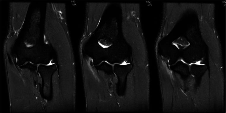 Serial coronal proton-density MRI images showing a partial proximal elbow UCL tear