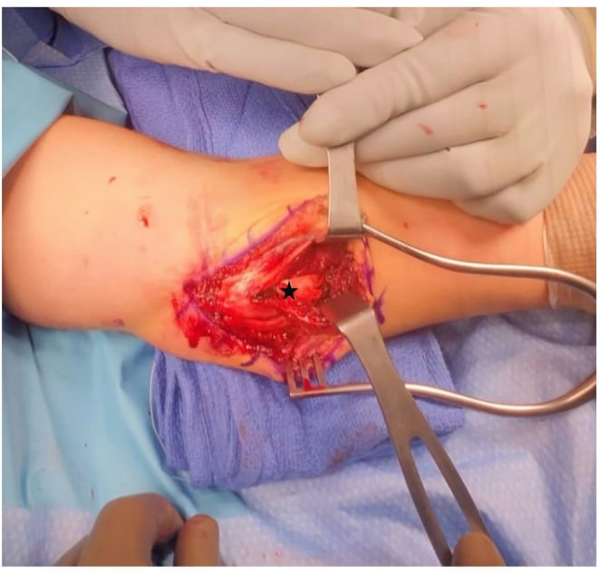Medial operative exposure of a left elbow showing the two limbs of a UCL reconstruction graft