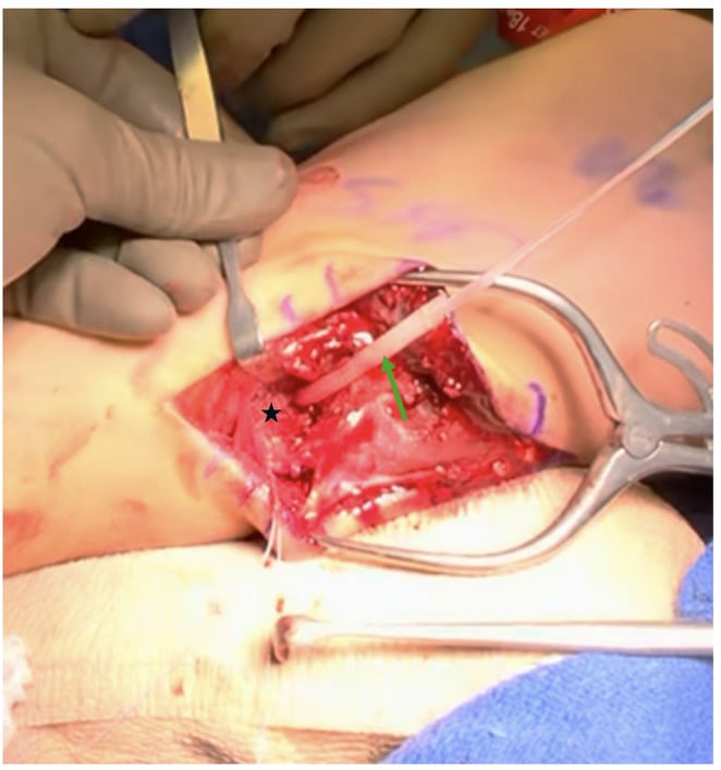 Medial operative exposure of a right elbow showing UCL repair with suture-tape augmentation