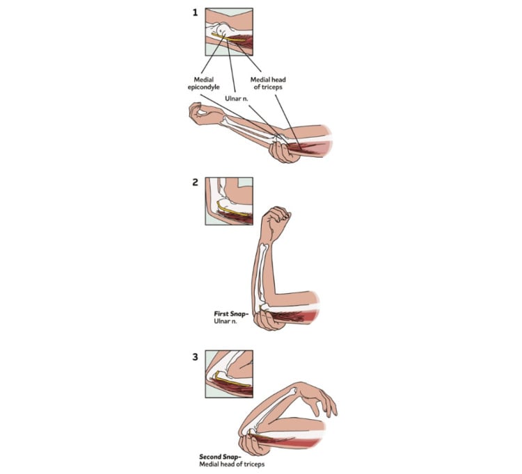 Three-step illustration showing the ulnar nerve moving over the medial epicondyle during elbow flexion