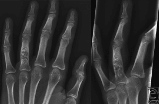 Enchondroma of proximal phalanx on hand X-ray