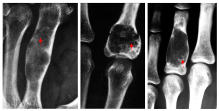 Radiograph of a phalangeal enchondroma with a well-defined lytic lesion containing calcified matrix