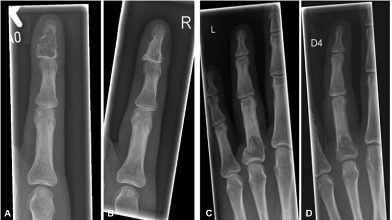 Radiographs before and six years after curettage of a distal phalangeal enchondroma, and a pathological fracture through a proximal phalangeal lesion