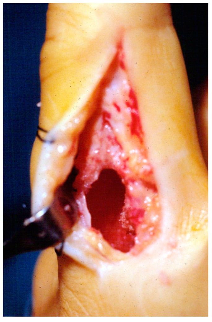 Intraoperative photograph of a lateral cortical window in a proximal phalanx with curettage of the lesion