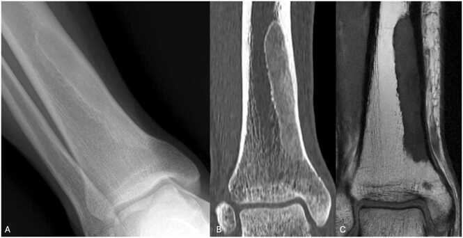 Radiograph, CT and MRI of ground-glass fibrous dysplasia of the distal tibia